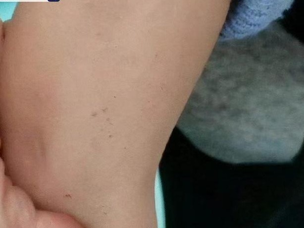 陕西蒲城一女教师针扎幼儿案宣判：获刑8个月