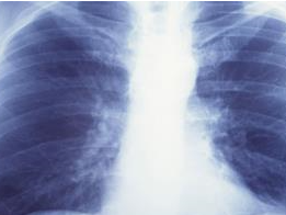 2020年深圳平均每天新发恶性肿瘤84例，肺癌仍是头号杀手