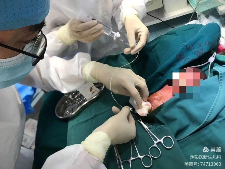 彭湃纪念医院成功为740克超早早产双胞胎完成脐静脉置管术